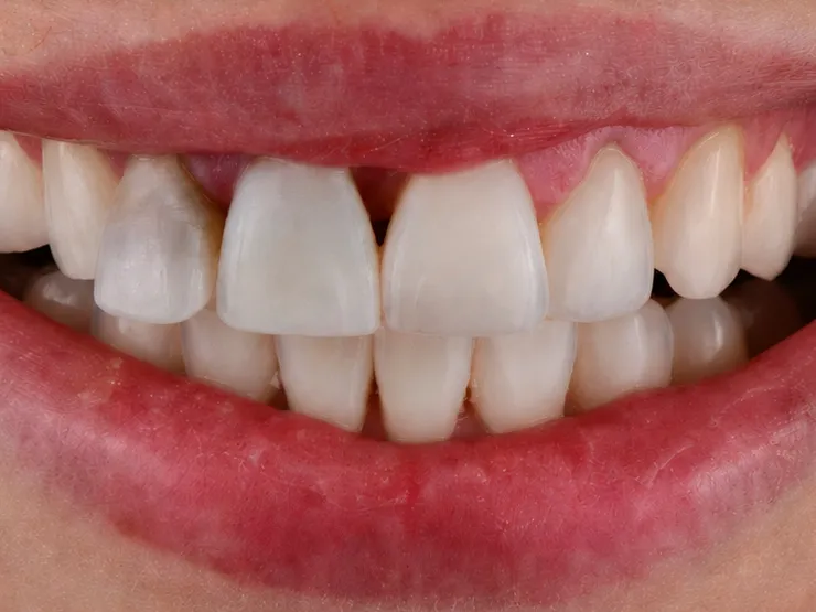 Before: close-up of a smile with worn, uneven, and discolored upper front teeth