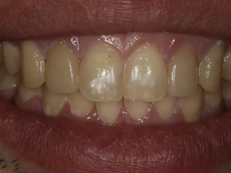After: the same upper front teeth restored with veneers, with smooth, even edges